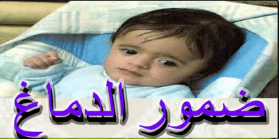 علاج ضمور الدماغ dxn