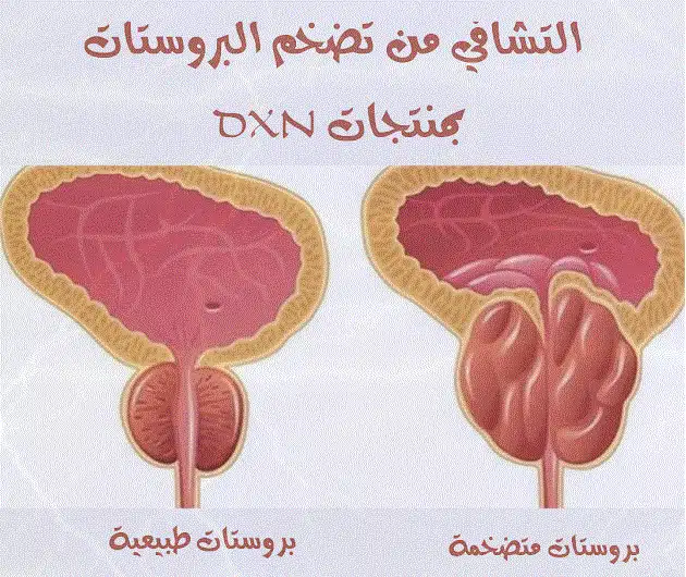 تجارب علاج التهاب البروستاتا