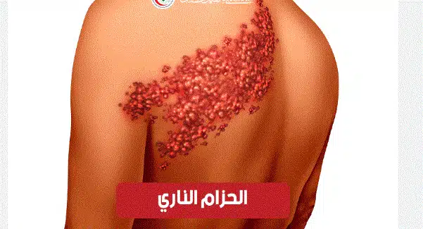 علاج الحزام الناري طبيعيا بمنتجات dxn