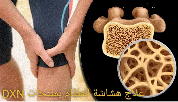مكملات غذائية لهشاشة العظام