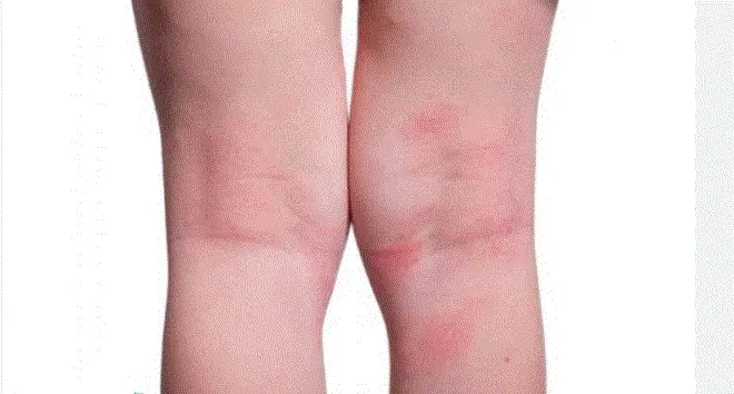 افضل علاج طبيعي للتسلخات
