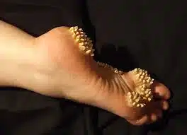 حالة تشافي من مسمار القدم باستخدام منتجات DXN