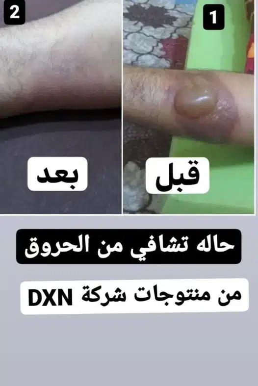 حالات تشافي بمنتجات dxn للحروق