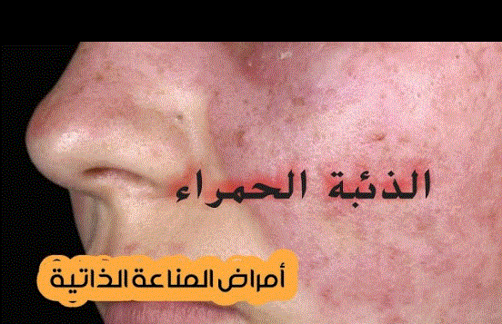 منتجات DXN للذئبة الحمراء
