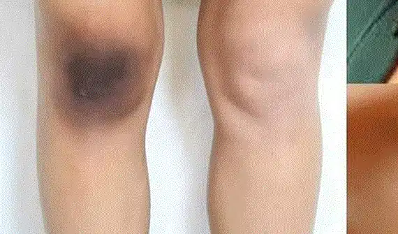 كيفية التخلص من سواد الركبة والكوع طبيعياً