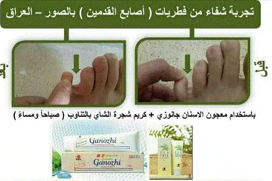 شفاء فطريات الأصابع بمنتجات DXN