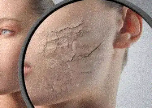 وصفة طبيعية لجفاف الوجه