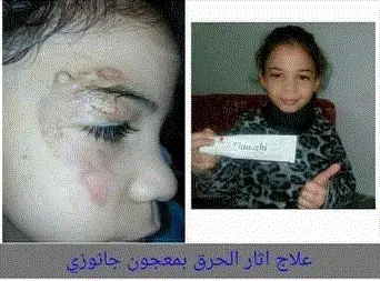 حالة شفاء مذهلة من الحروق بمعجون الجانوزي (تجربة فريدة!) 1