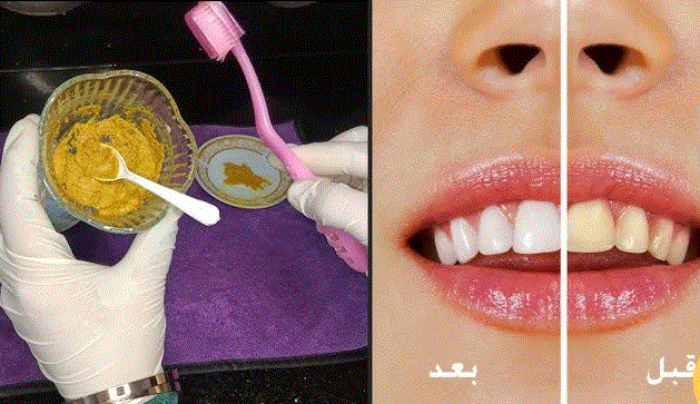 تبييض الأسنان طبيعياً