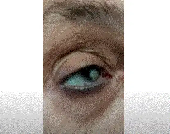(تحسن مذهل!) كيف تخلصت سيدة من المياه البيضاء بالفطر الريشي! 1