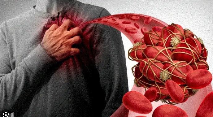 هل لاحظت انتشار الجلطات مؤخرًا؟ كيف تحمي نفسك طبيعيًا ؟
